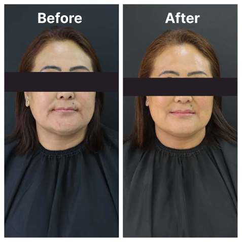 Eyelid Surgery KOQ10